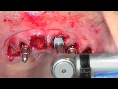 Dental Implant Surgery Teeth in a Day with Active Implants and Ot Equator