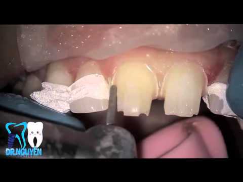 Watch Dental Crown & Bridge Procedure